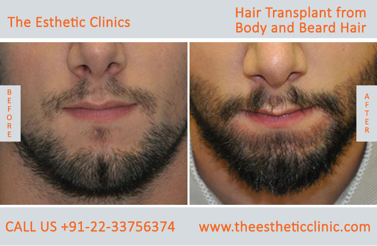 Hair Transplant from Body and Beard Hair before after photos mumbai (2)
